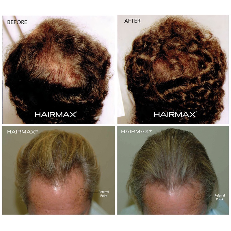 מוצר חדש בארץ: HairMax - מכשיר ביתי לטיפול בבעיית התקרחות ודלילות השיער בקרב נשים וגברים